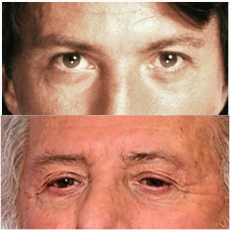 What About Blepharoplasty?
