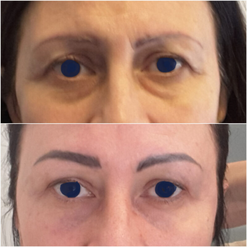 Mini-Invasive Morphodynamica Blepharoplasty.