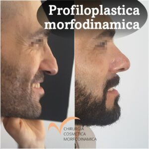 Profiloplastica Morfodinamica.