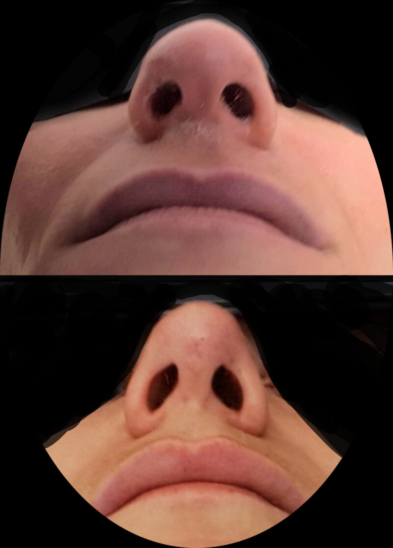Minimally invasive Rhinoplasty.